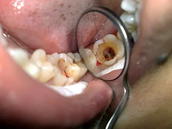 Điều trị tủy răng