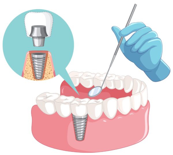 Implant